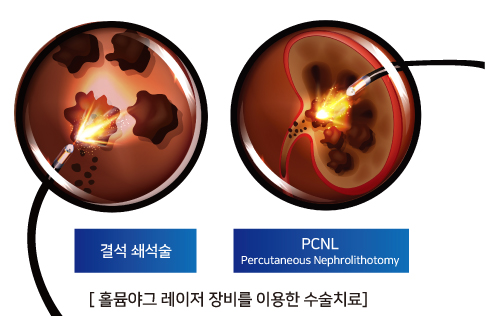 VIP동물수술센터의 안전한 레이저 수술, 무절개 결석수술